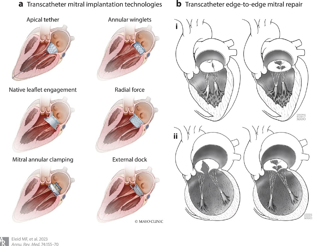 Enfermedad Valvular Card Aca