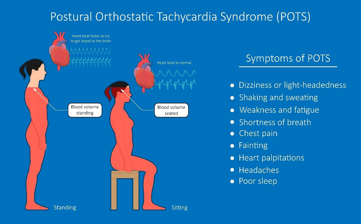 Nuestra Comunidad - ¿Qué es el síndrome de taquicardia postural ortostática?