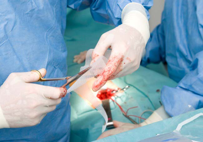 Prevención de la eventración en cirugía abdominal abierta - Artículos -  IntraMed