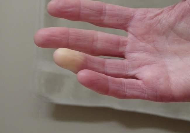 Puntura no sangrante, eritema y edema leve localizado en tercer dedo de