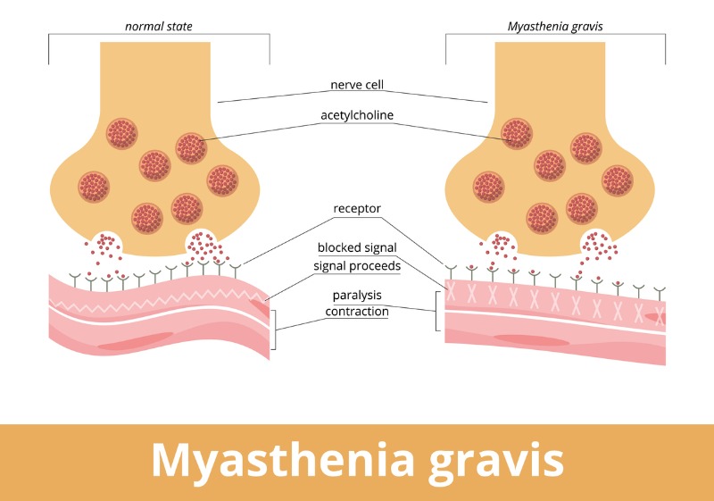 Miastenia gravis: preguntas frecuentes