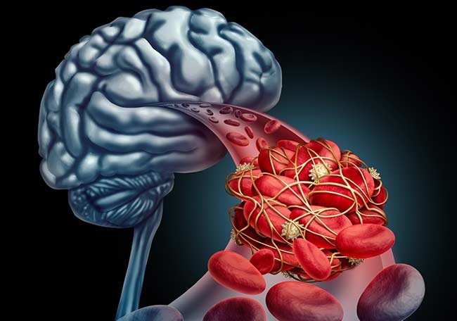 Acidente Vascular Cerebral e Outras Doenças Cerebrovasculares o