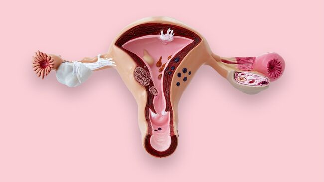 Teratoma de ovário pode se tornar câncer?